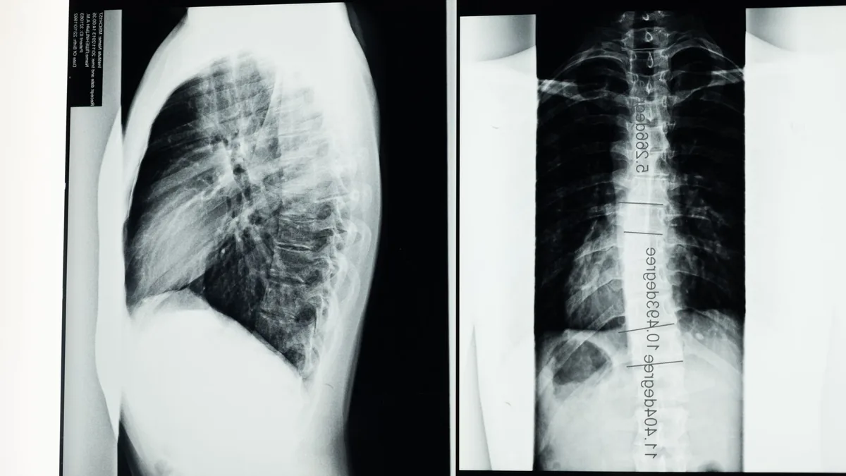 High-resolution X-ray showing a detailed examination of human spine with scoliosis.
