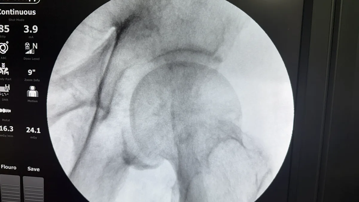 Fluoroscopic image of a hip showing severe osteoarthritis with degenerative joint changes along the lower joint.