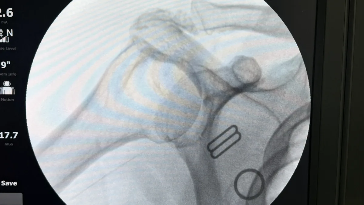 Fluoroscopic image of a shoulder showing severe erosion of the joint from arthritis.