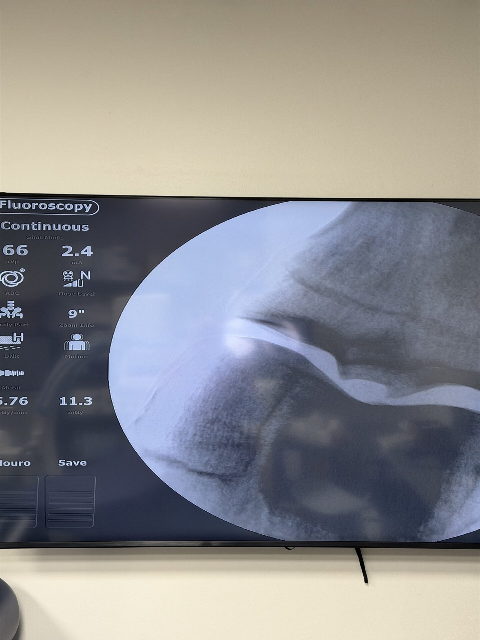 Fluoroscopic image of a knee joint displayed on the procedure-suite monitor at Regen.MD, 4477 Woodson Rd, St. Louis
